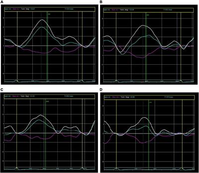 Evaluation of anthracycline-induced subclinical LV dysfunction by using myocardial composite index and two-dimension speckle tracking echocardiography technique